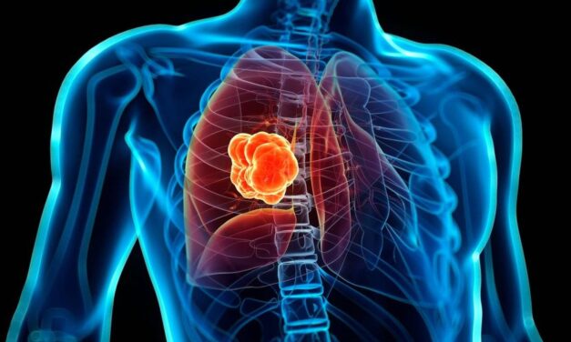 Tratamiento en España logra erradicar el cáncer de pulmón un 37%