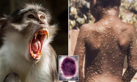 ¿Qué es la viruela del mono y cómo evitar el contagio?