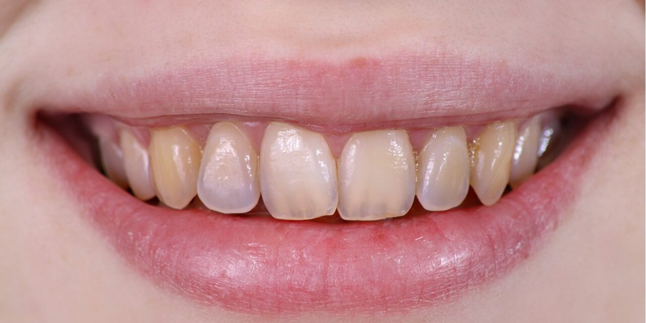 Científicos crean esmalte dental artificial más duro que el natural
